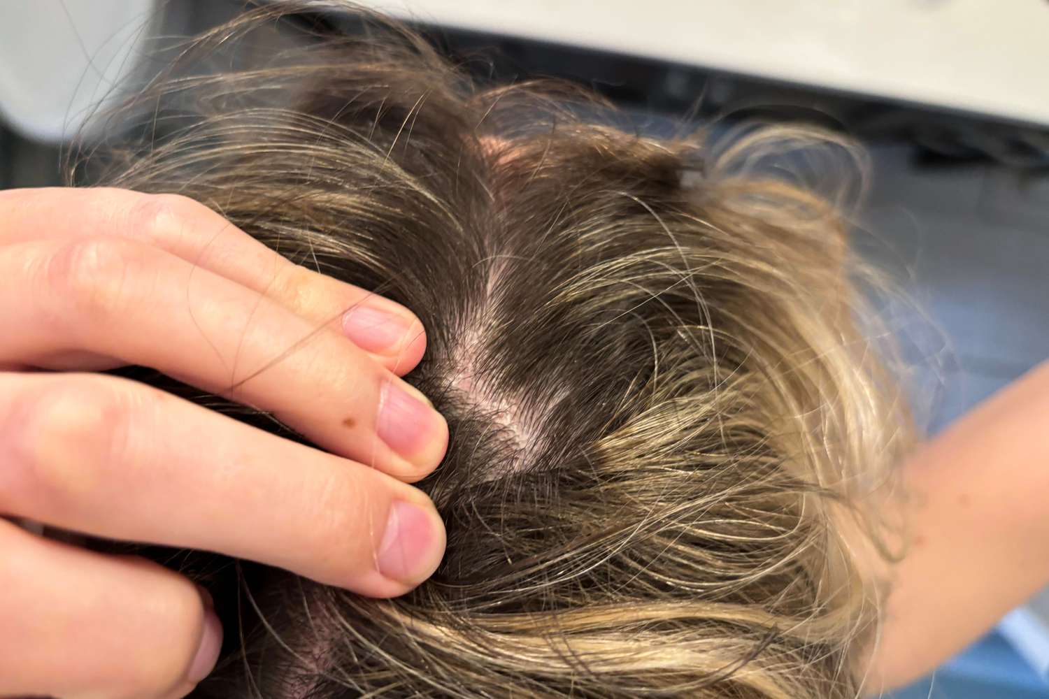 Is Tirzepatide transforming diabetes management or causing unexpected hair loss? Join us as we explore the side effects of this revolutionary drug and what they mean for your hair health.